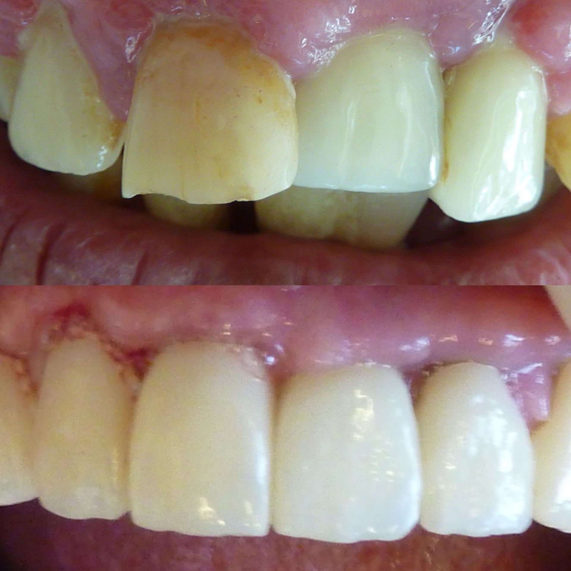 Une photo avant et après des dents d'une personne