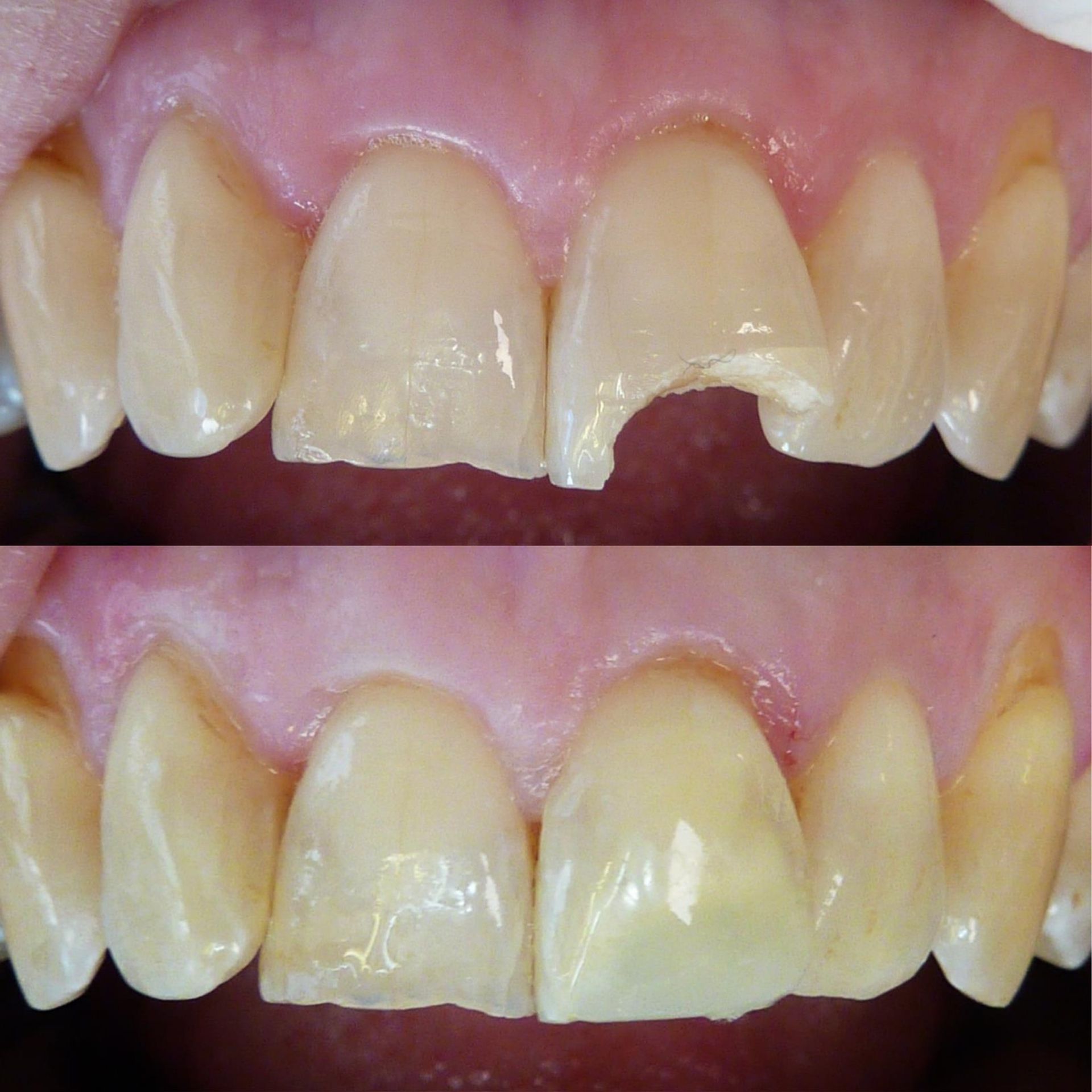 Une photo avant et après des dents d'une personne.