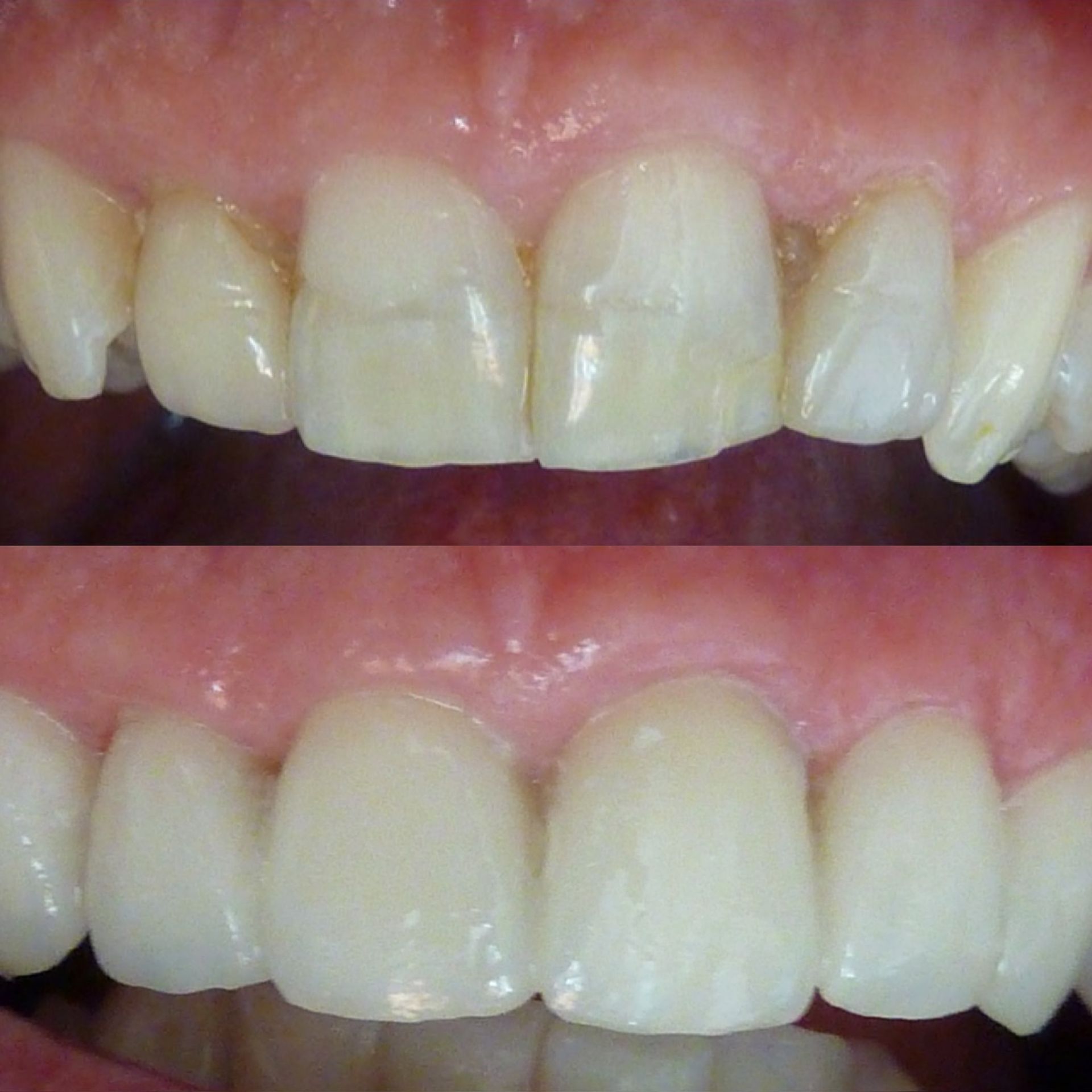 Une photo avant et après des dents d'une personne
