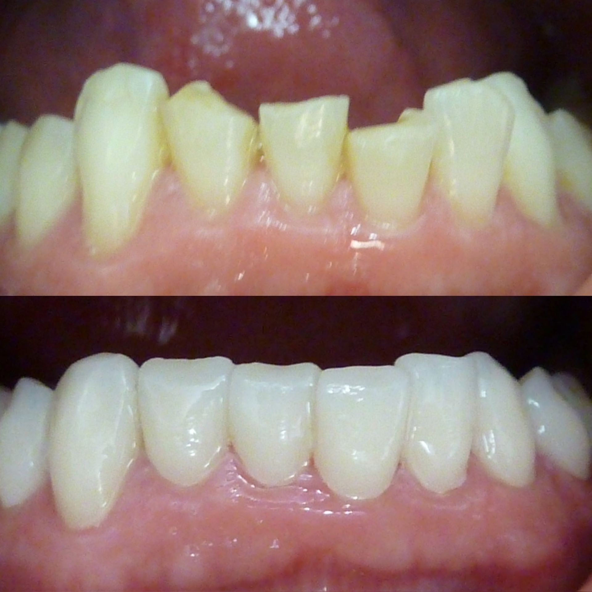 Une photo avant et après des dents d'une personne