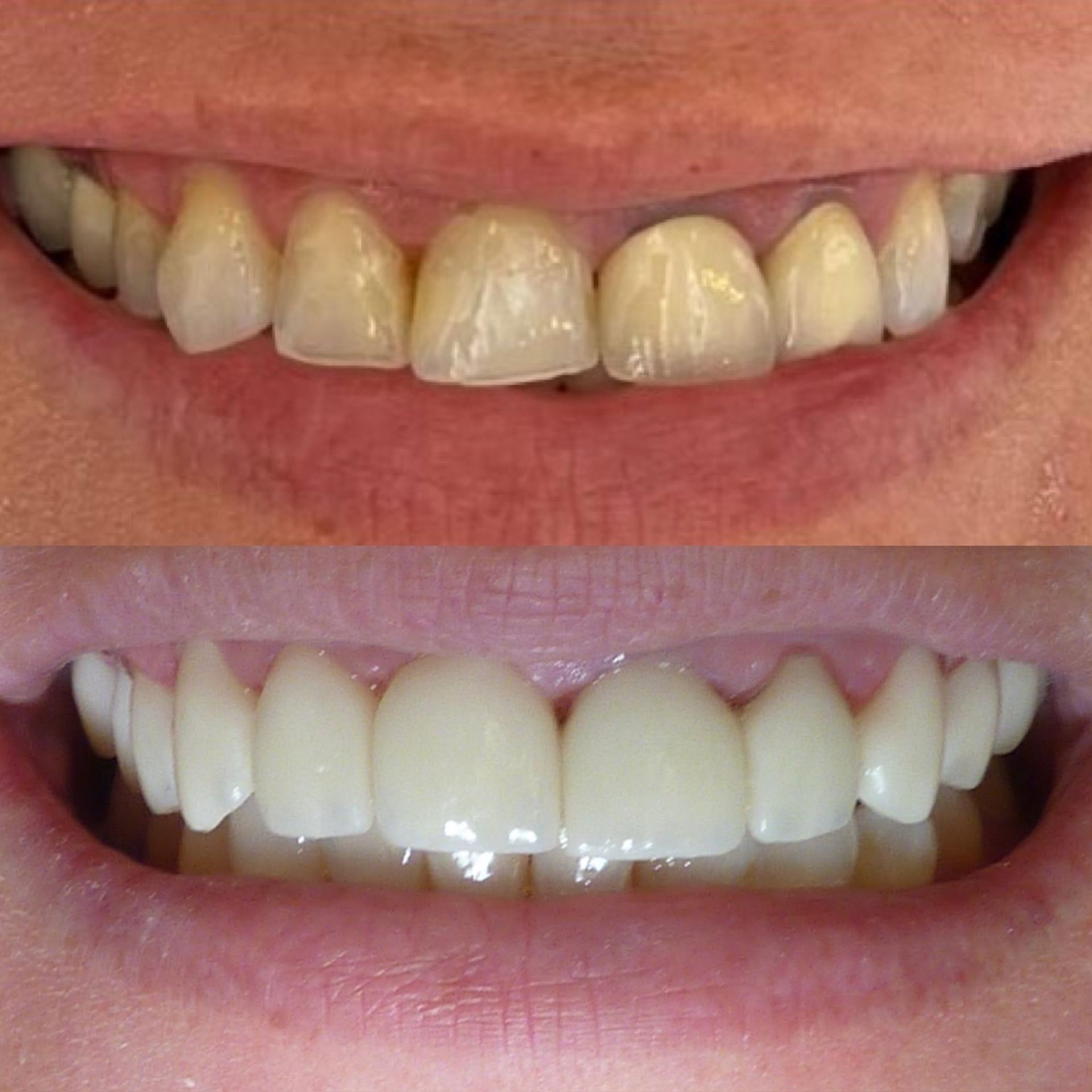 Une photo avant et après des dents d'une personne.