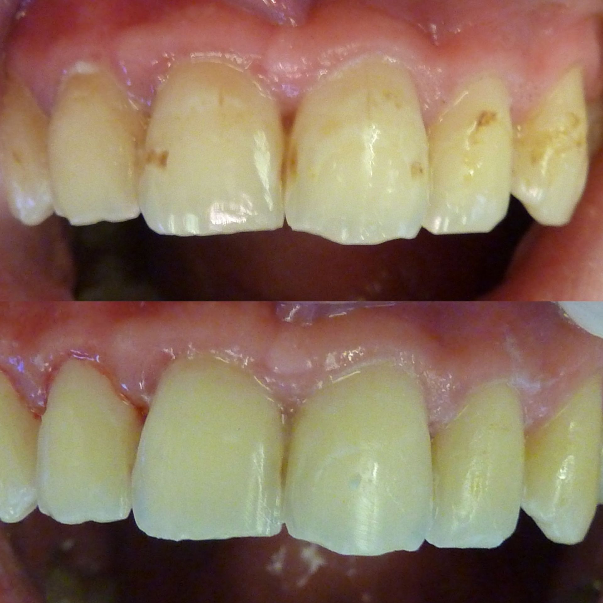 Une photo avant et après des dents d'une personne