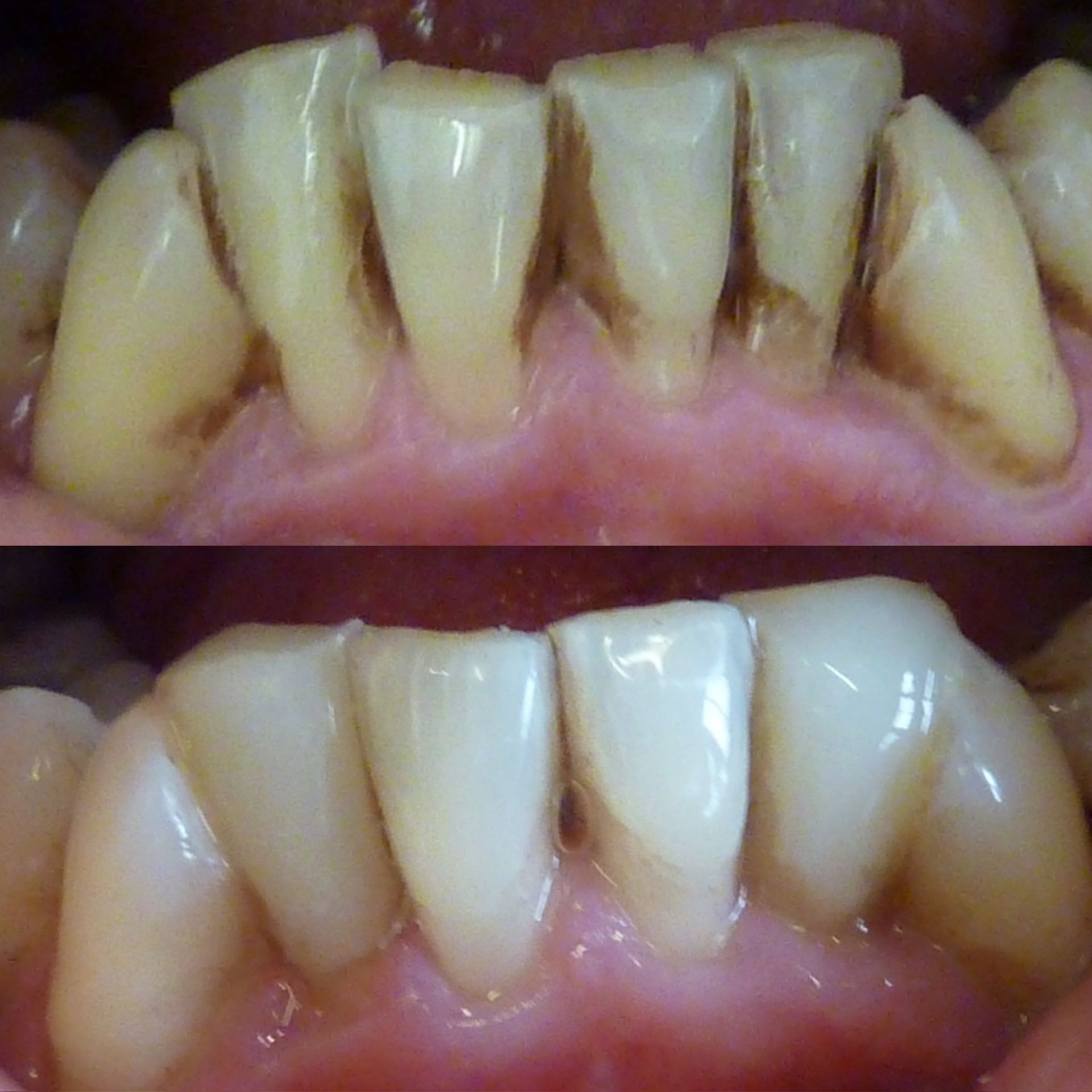 Une photo avant et après des dents d'une personne.