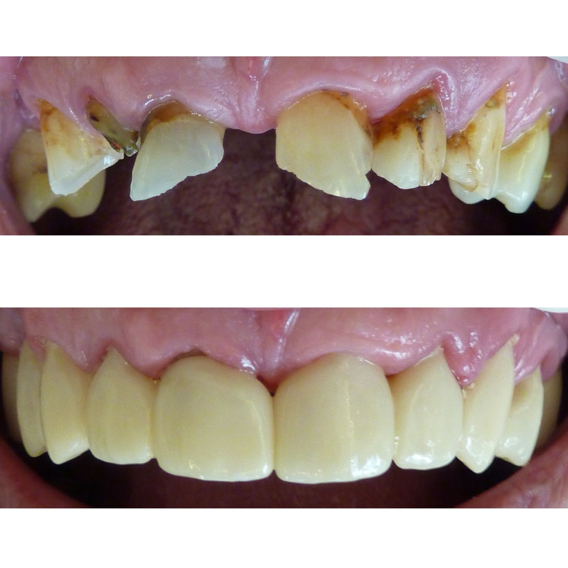 Une photo avant et après des dents d'une personne.