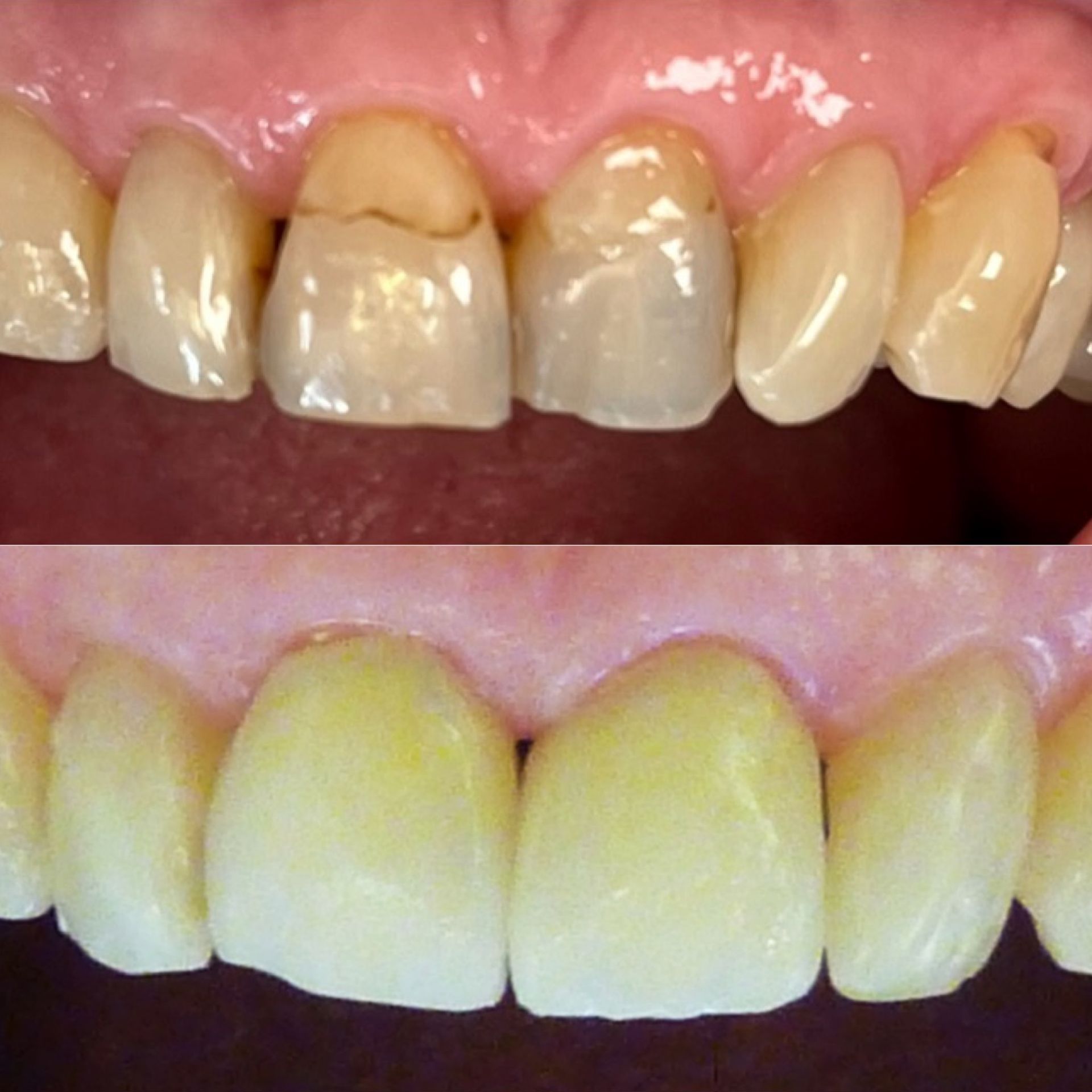 Une photo avant et après des dents d'une personne