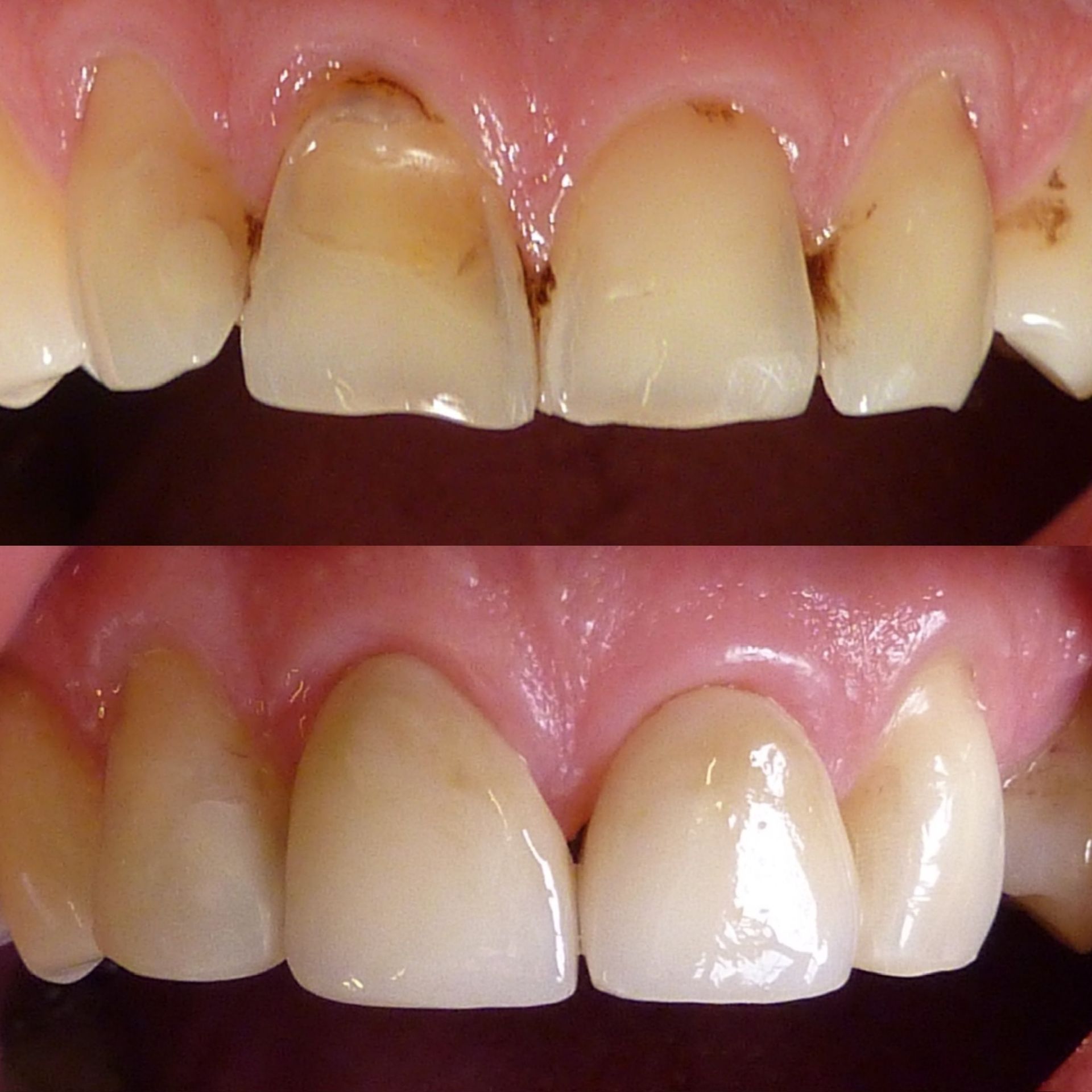 Une photo avant et après des dents d'une personne