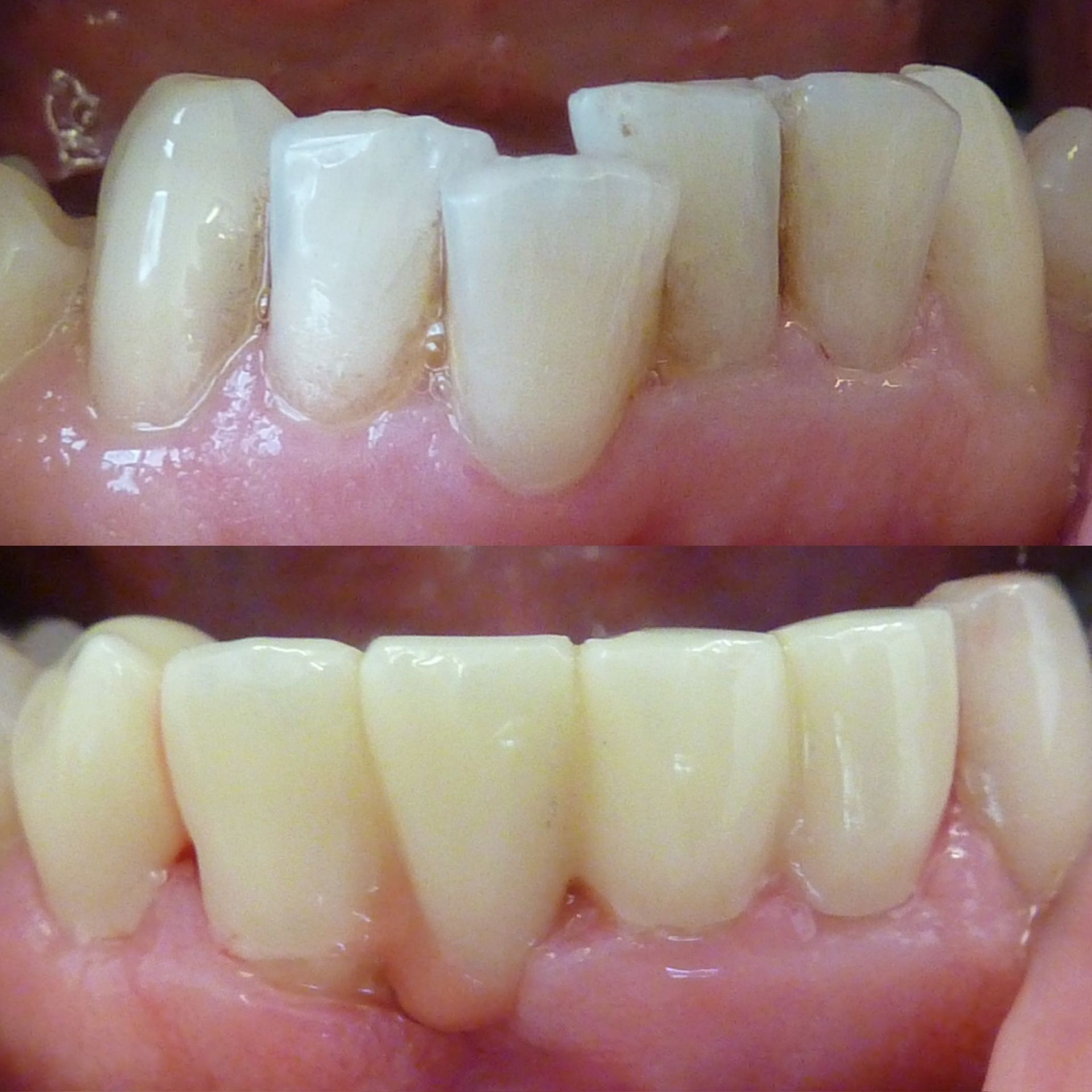 Une photo avant et après des dents d'une personne