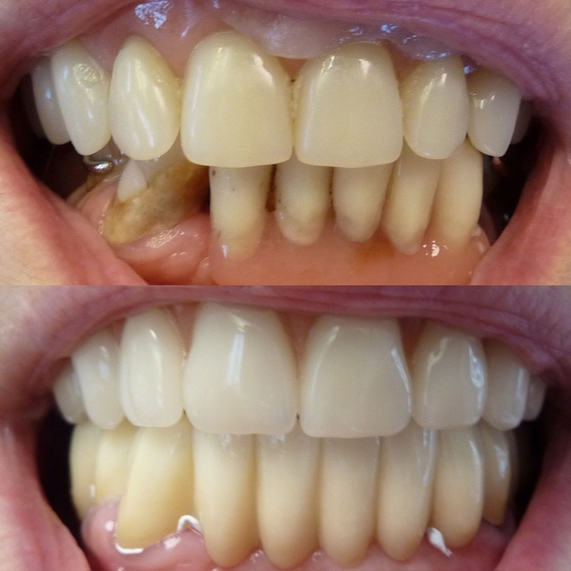 Une photo avant et après des dents d'une personne