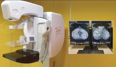 Apparecchio per la mammografia accanto a un monitor che mostra le immagini di una scansione mammaria in un contesto clinico.