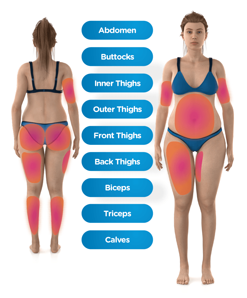 Body Areas Treated by Emsculpt Neo: Abdomen, Buttocks, Thighs, Arms, and Calves