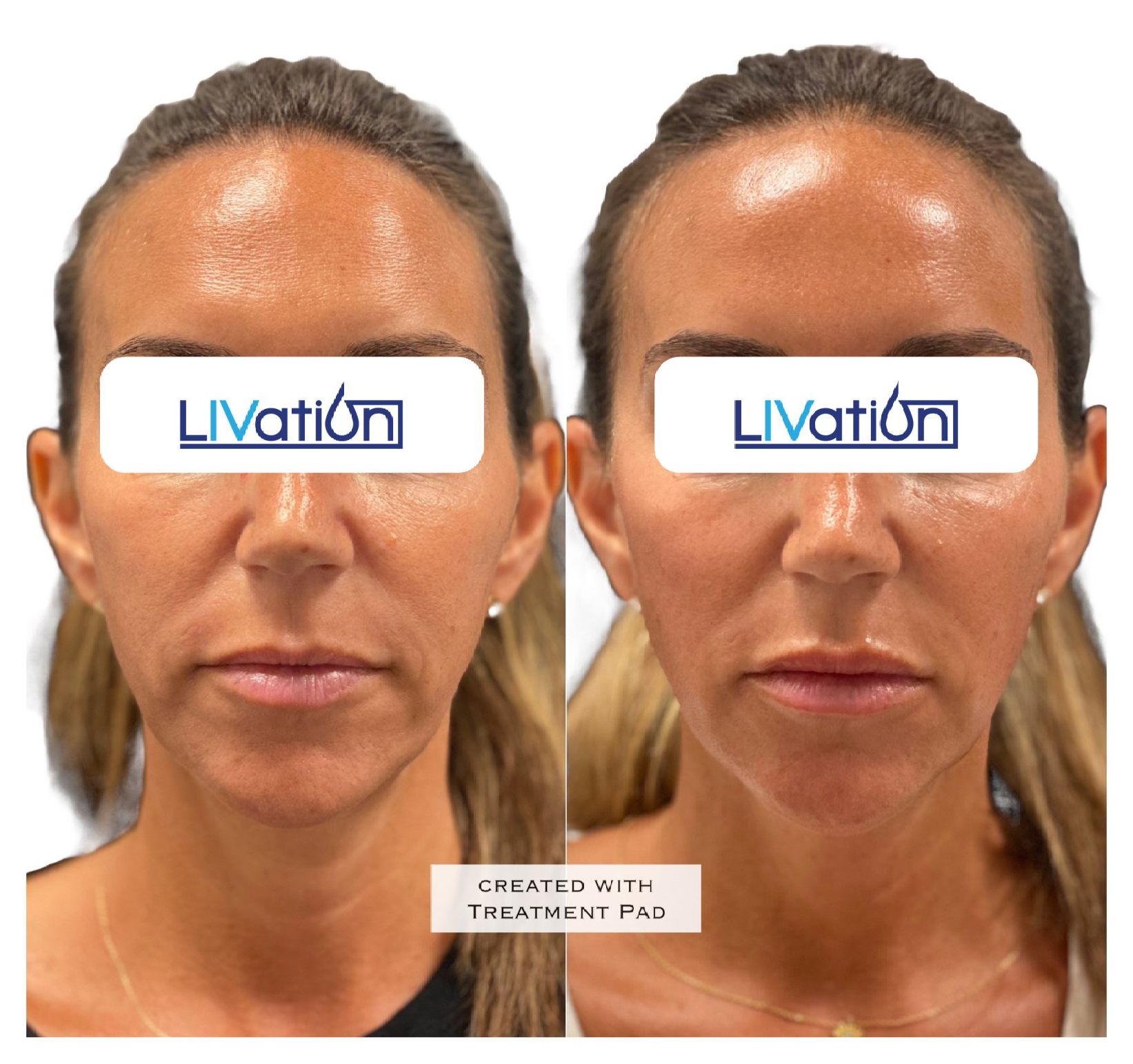 triLift Facelift Before & After 2