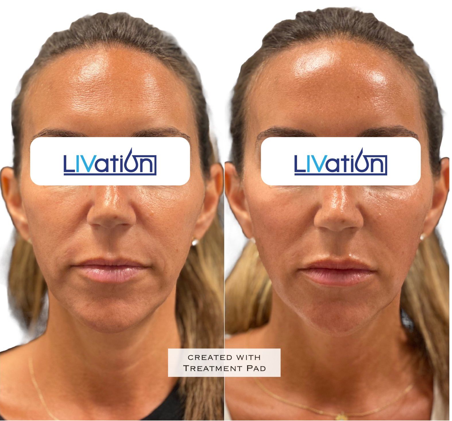 Before and After Results of LIVation TriLift Eye Treatment in CT