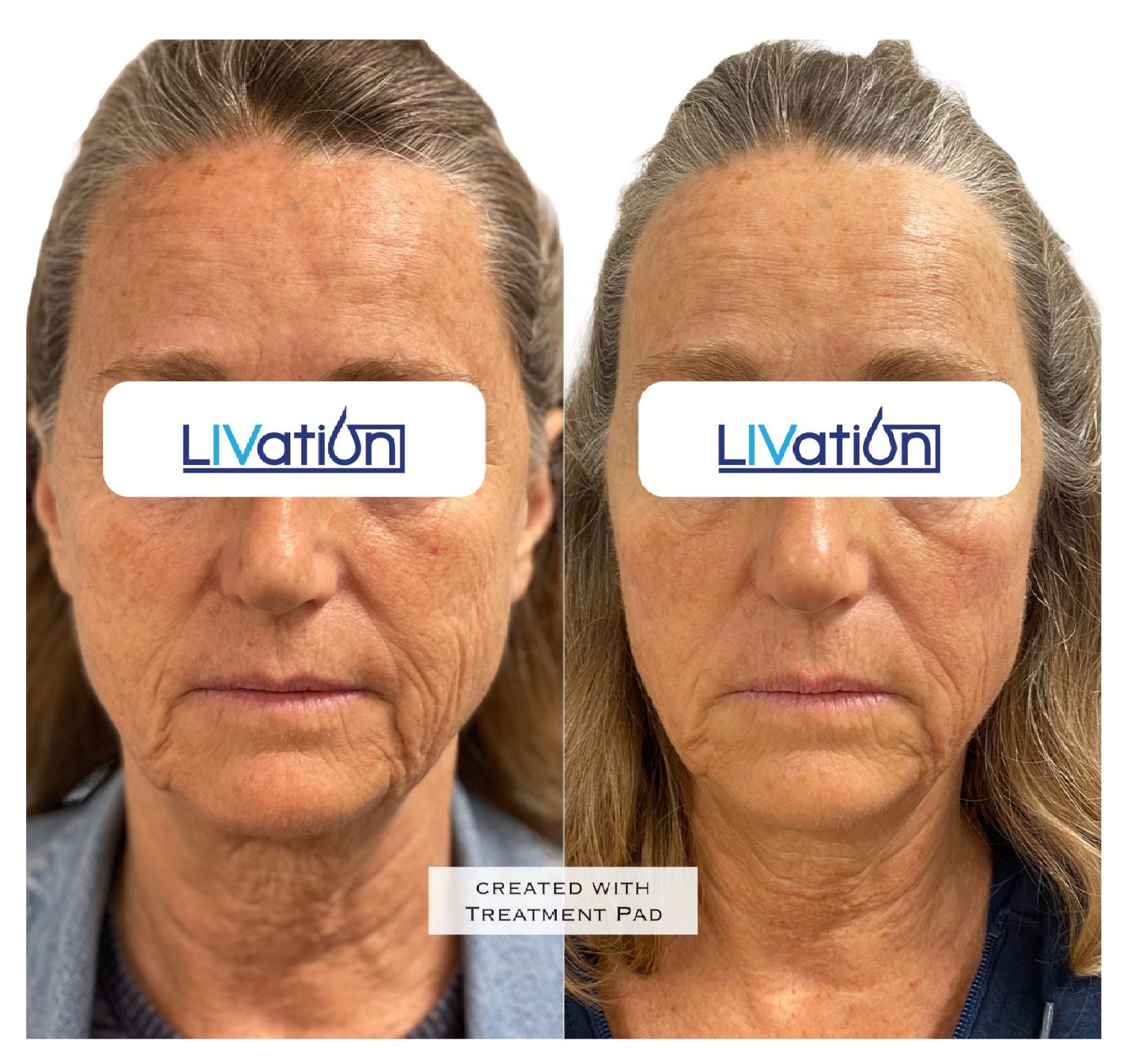 triLift Facelift Before & After 3