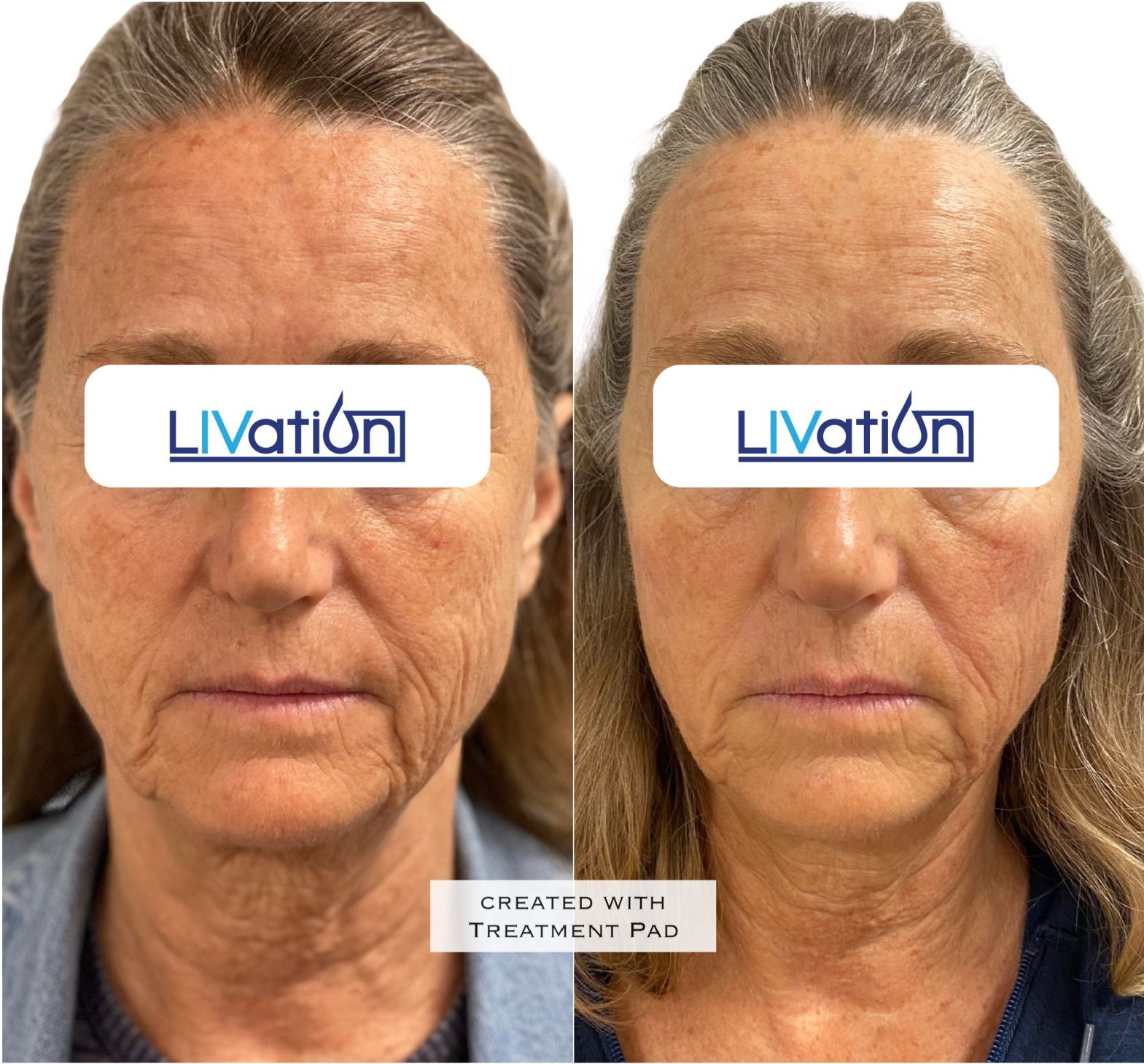 Before and After Results of LIVation TriLift Eye Treatment in CT