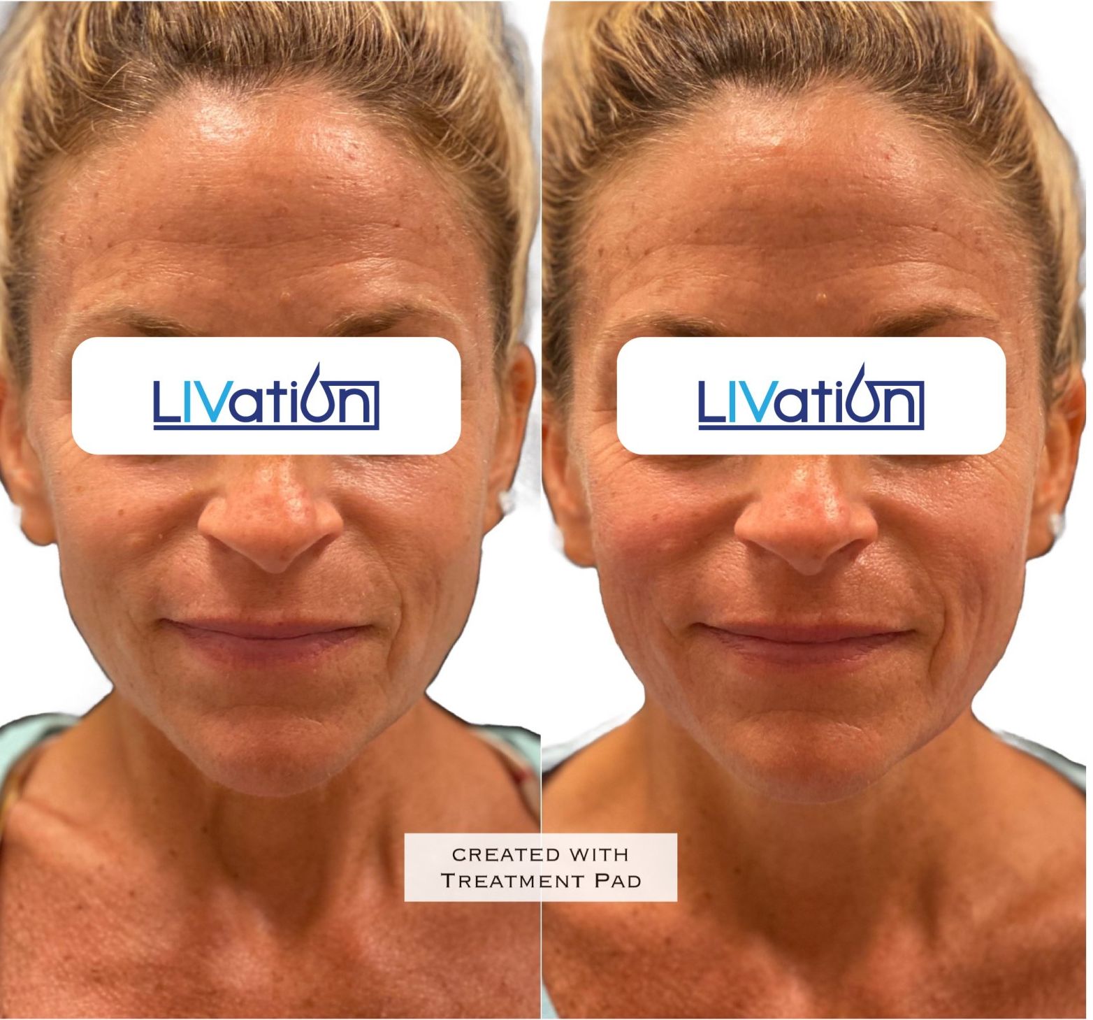 TriLift Device in CT for Advanced Skin Rejuvenation Before & After Eyes