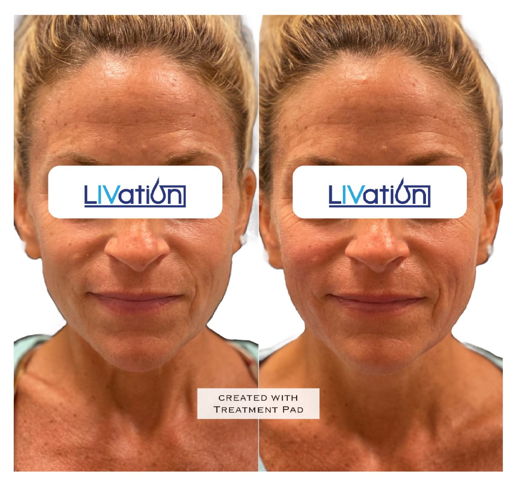 triLift Facelift Before & After