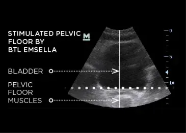 Emsella Device for Pelvic Floor Strengthening in CT