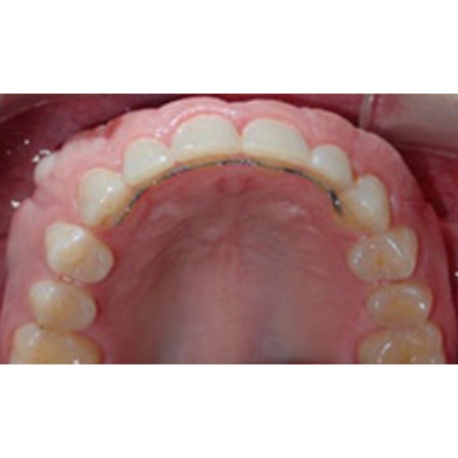 Upper Teeth Photo Example