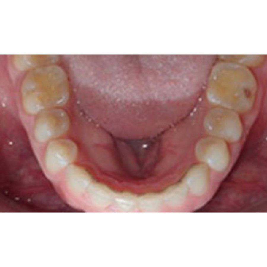 Bottom Teeth Photo Example