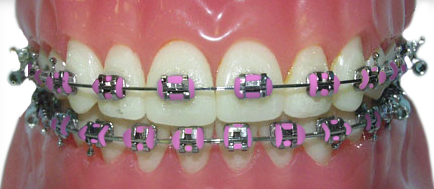 braces with pink rubber bands for Breast Cancer Awareness