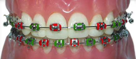 braces with red and green rubber bands for Christmas