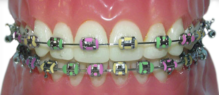 braces with pastel rubber bands for Easter