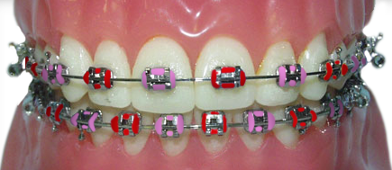 braces with red and pink rubber bands for Valentine's Day