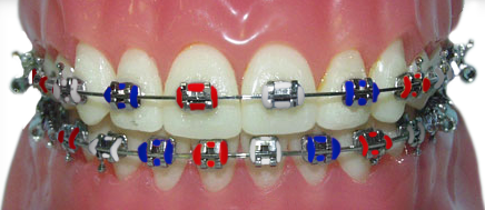 braces with red, white and blue rubber bands for New Years, 4th of July or Memorial Day