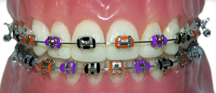 braces with orange, black and purple rubber bands for Halloween