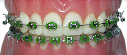 braces with green rubber bands for St. Patrick's Day