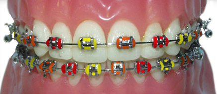 braces with red, orange and yellow rubber bands for Autumn