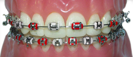 braces with red and white rubber bands for the Alabama Crimson Tide