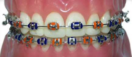 braces with orange and blue rubber bands for the Auburn Tigers