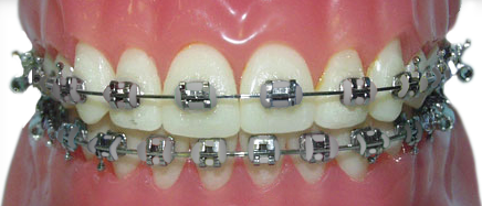 braces with silver rubber bands for a subtle look