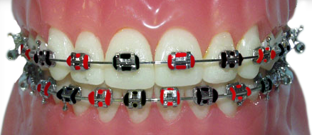braces with red and black rubber bands for the Birmingham Barons