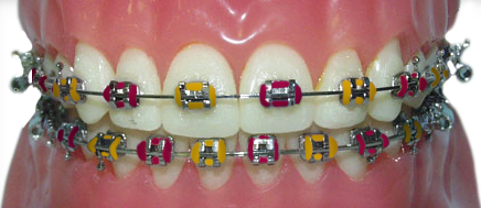 braces with gold and red rubber bands for the Birmingham Stallions