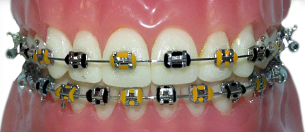 braces with black and gold rubber bands for the Birmingham Legion
