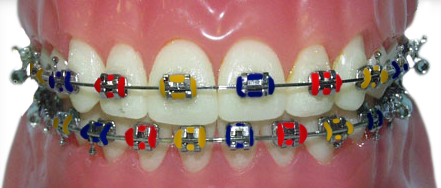 braces with blue, red and yellow rubber bands for the Birmingham Squadron