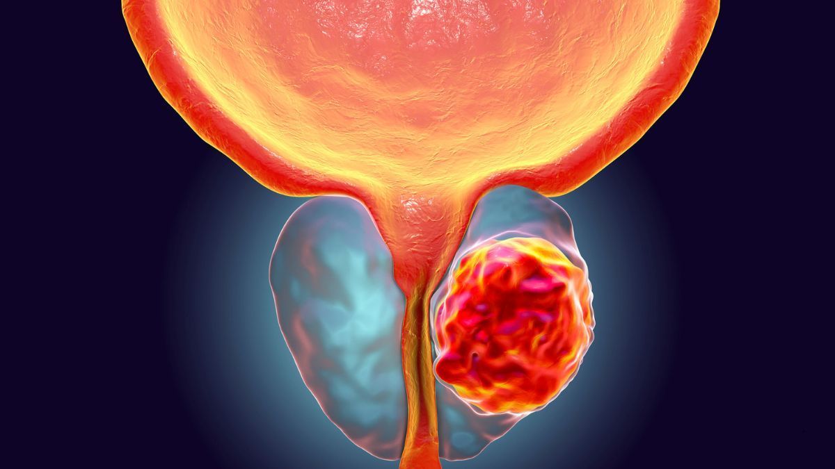 Il Tumore della Prostata
