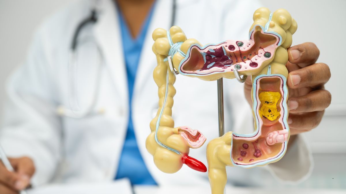 Malattie Infiammatorie Croniche Intestinali (MICI), Colon Irritabile e Sistema Immunitario 