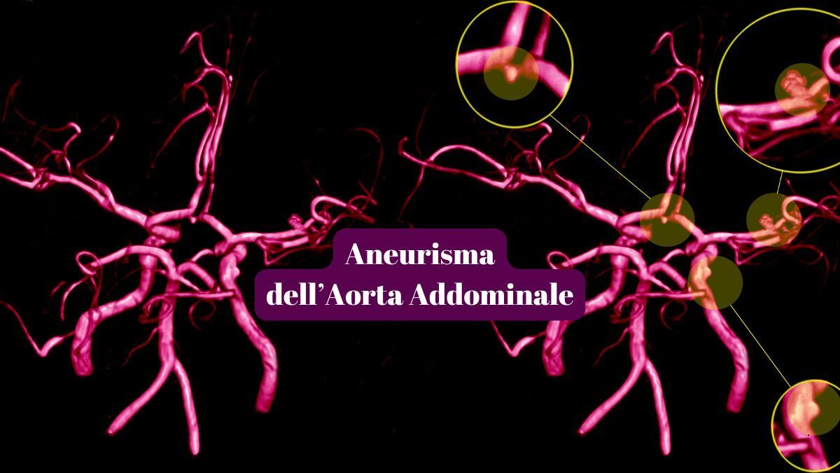 Aneurismi dell’aorta addominale: Cause, Sintomi e Trattamenti | Poliambulatorio IGEA Piacenza