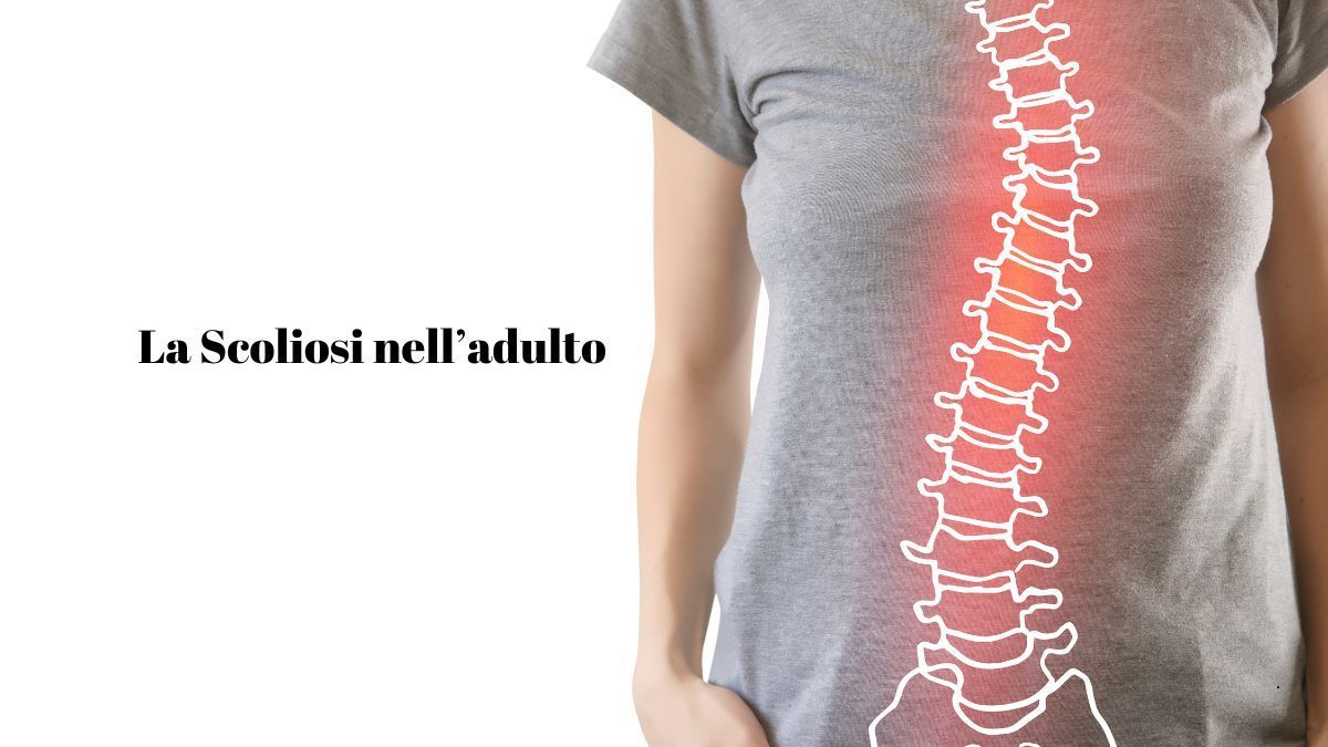 La Scoliosi nell'Adulto: Cause Sintomi e Trattamento | Poliambulatorio IGEA Piacenza