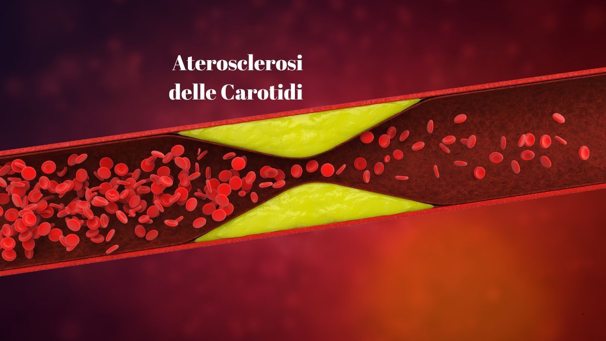 Aterosclerosi delle Carotidi: Cause, Sintomi e Trattamenti | Poliambulatorio IGEA Piacenza