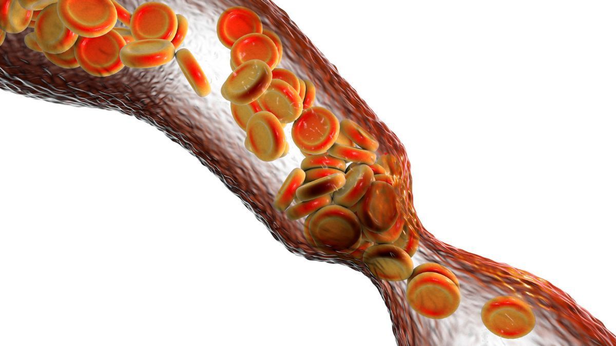 La Stenosi Vascolare | Poliambulatorio IGEA Piacenza