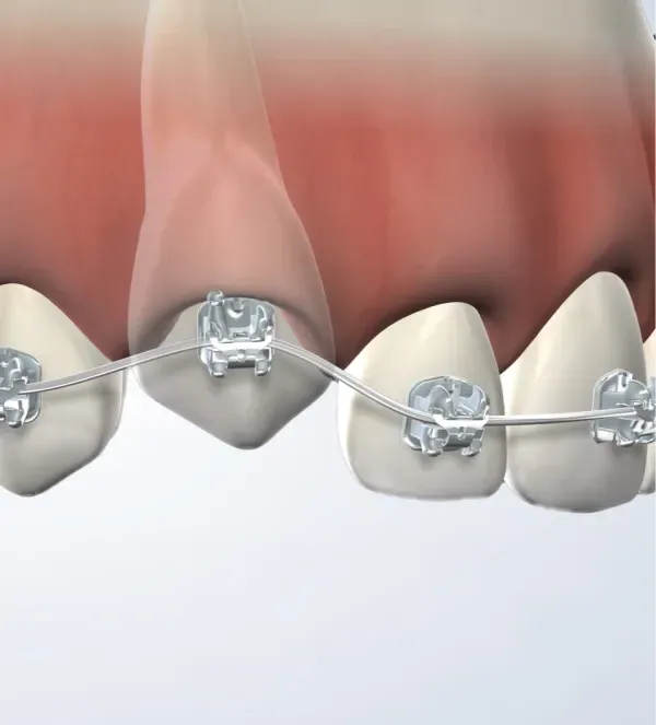 Impacted Tooth Exposure