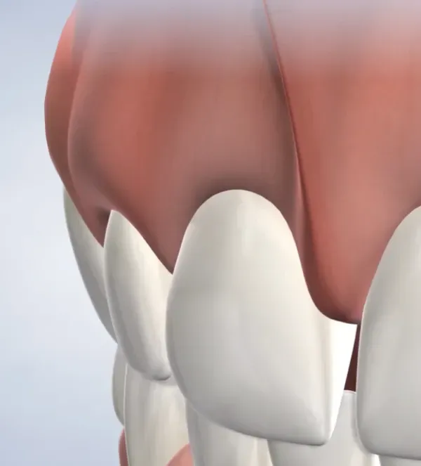 Labial and Lingual Frenectomies