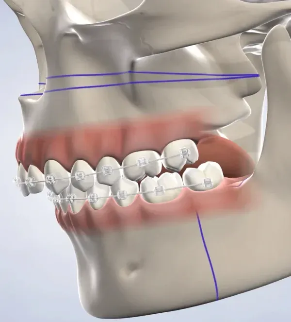 Orthognathic Surgery