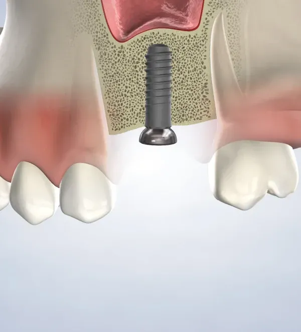 Bone Grafting & Bone Augmentation