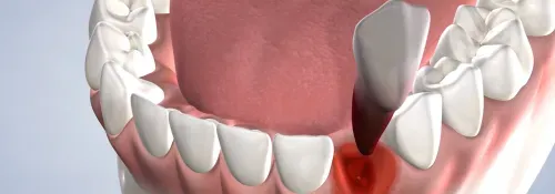 A close up of a dental implant with a tooth in it.