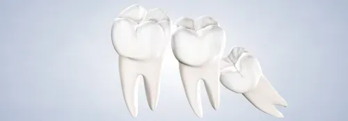 A close up of a dental implant with a tooth in it.